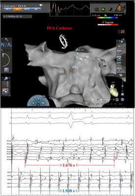 Pulsed field ablation of superior vena cava in paroxysmal atrial fibrillation: a case report